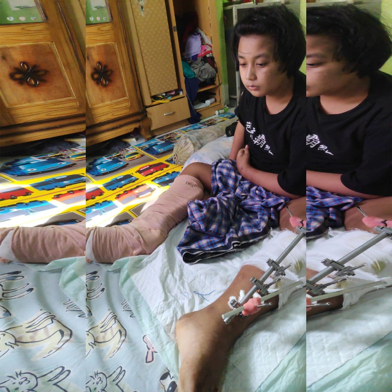 Bantu Iqbal Yatim Piatu sembuh dari Patah Tulang & Lumpuh supaya bisa sekolah kembali.
