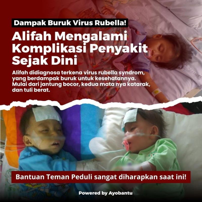 Bantu alifah berjuang dari virus rubella syndrom kogiental
