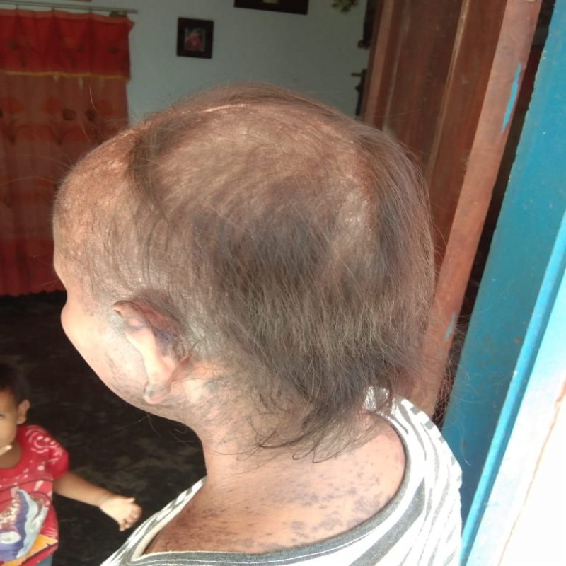 Lupus Gerogoti rambut dan kulit, bantu Ibu Sri sembuh