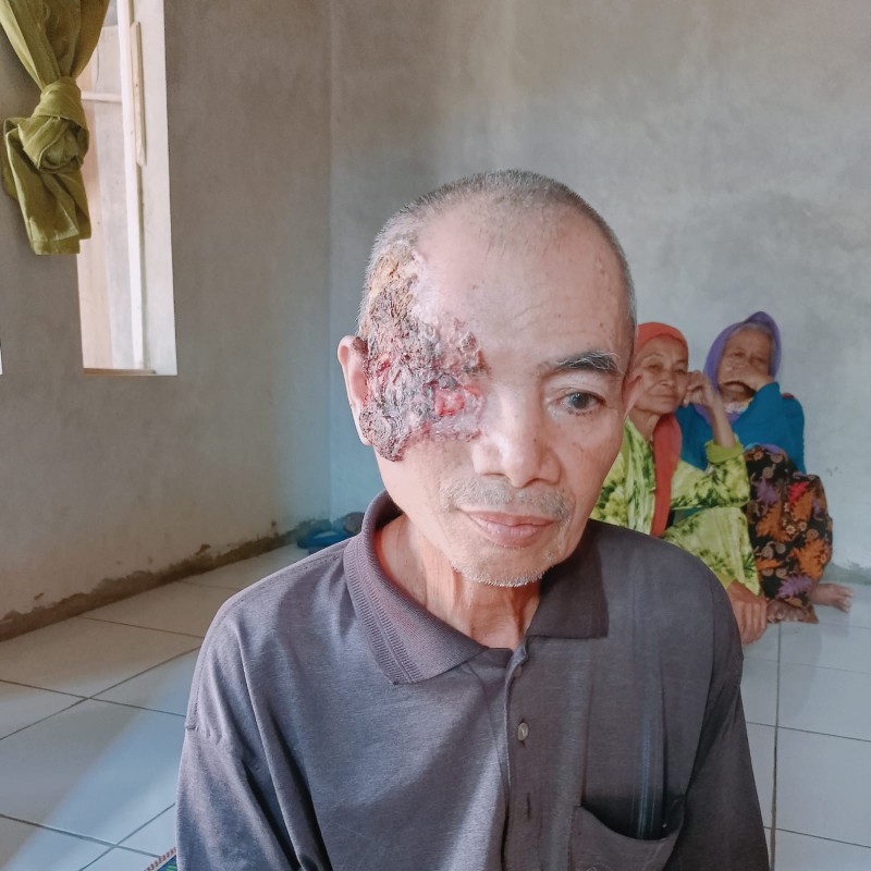 Kanker Ganas Merusak Mata dan Setengah Wajah, Bantu Pak Koko Segera Jalani Operasi